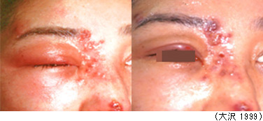 皮下注射法の治療前・治療後