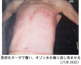 オゾン水による熱傷治療の治療前