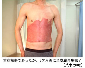 オゾン水による熱傷治療の治療後